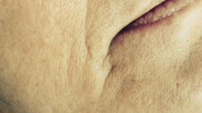 Softening of heavy folds and wrinkles  immediate result malta, dentist malta, dentistry malta, dental clinic malta, regional dental clinic malta