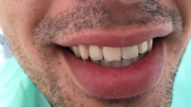 Cracked front tooth - repaired in 45 min malta, dentist malta, dentistry malta, dental clinic malta, regional dental clinic malta