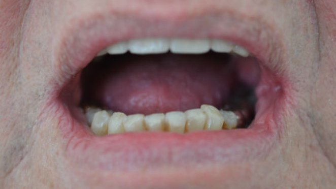 Severe wear on lower front teeth malta, dentist malta, dentistry malta, dental clinic malta, regional dental clinic malta