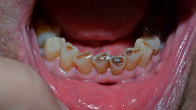 Severe wear on lower front teeth malta, dentist malta, dentistry malta, dental clinic malta, regional dental clinic malta