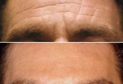 Forehead botulinum treatment. malta,  Facial Treatment Cases  malta, dentist malta, dentistry malta, dental clinic malta, regional dental clinic malta