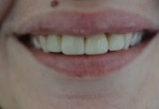 Combination of lip and dental treatment malta,  Cosmetic Dentistry Cases  malta, dentist malta, dentistry malta, dental clinic malta, regional dental clinic malta