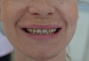 Amazing Transformation malta,  Cosmetic Dentistry Cases  malta, dentist malta, dentistry malta, dental clinic malta, regional dental clinic malta